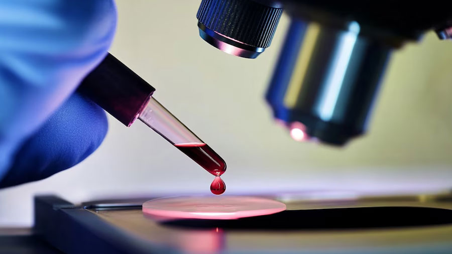 Parkinson: La Sangre Revela Secretos Ocultos Años Antes